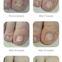 Samenwerkende Pedicures Kalknagels 75ml