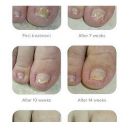 Samenwerkende Pedicures Kalknagels 75ml